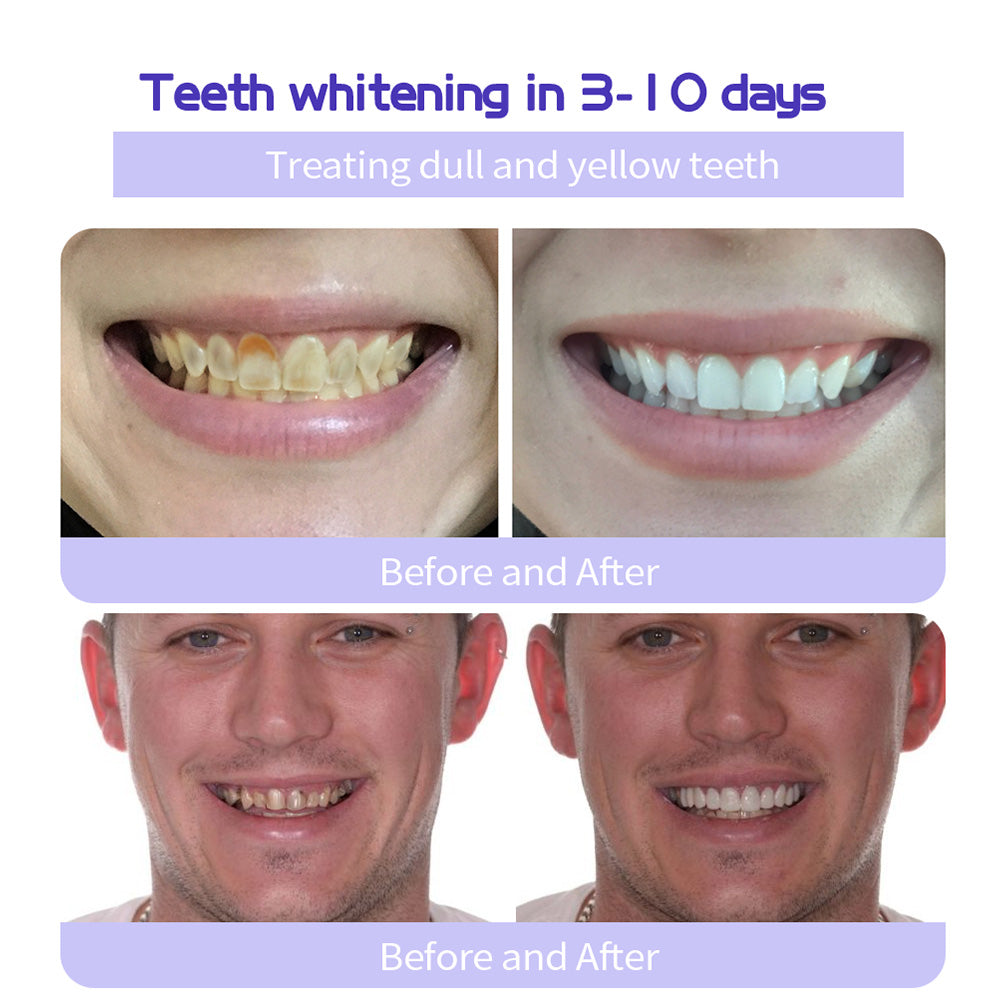 🔥Ends Tonight: Get 60% OFF Before It’s Gone!🎁Fluoride-Free Hydroxyapatite Toothpaste – Gentle Whitening & Enamel Strength for Sensitive Teeth